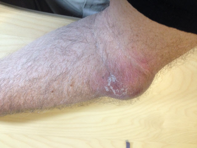 work-Hematoma%2520-%2520I%2520Am%2520Triathlete.jpg